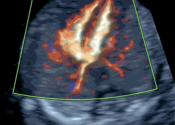 Early Fetal Echocardiography-content-1